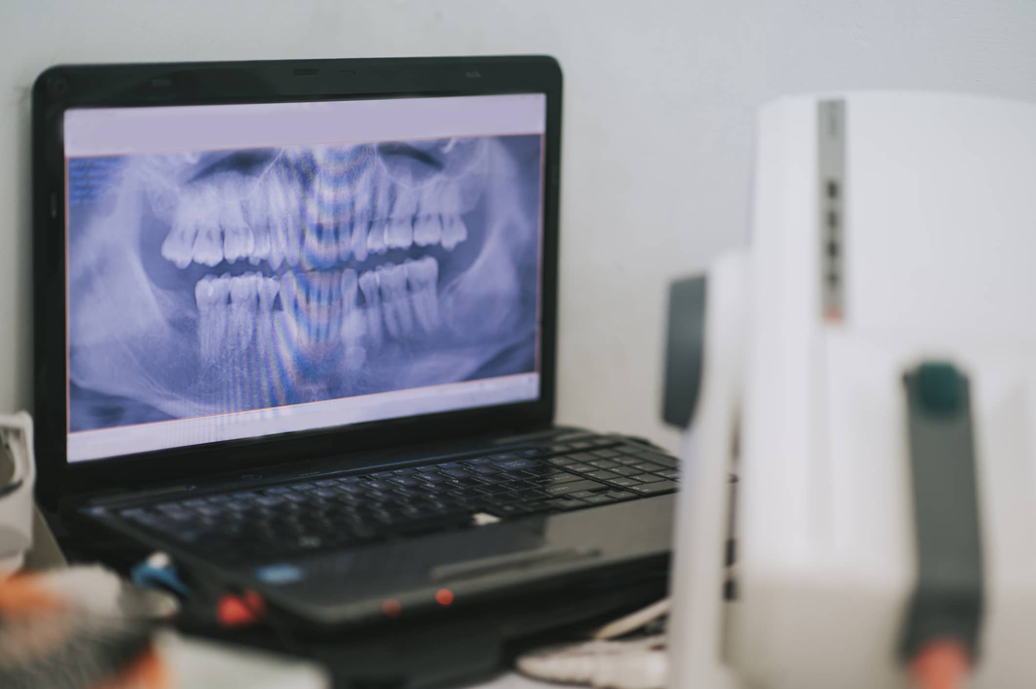X ray screen on laptop at dental office